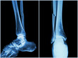 © stockdevil - Fracture shaft of fibula bone ( leg bone ) .  X-ray of leg