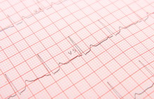 Electrocardiogram Graph Report
