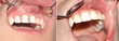 © DrTI - Caries before and after treatment