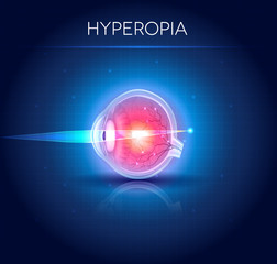 Poster - Hyperopia eyesight disorder