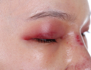 close-up of upper eye lid swell after nose job