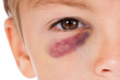 © valiza14 - Boy with bruise