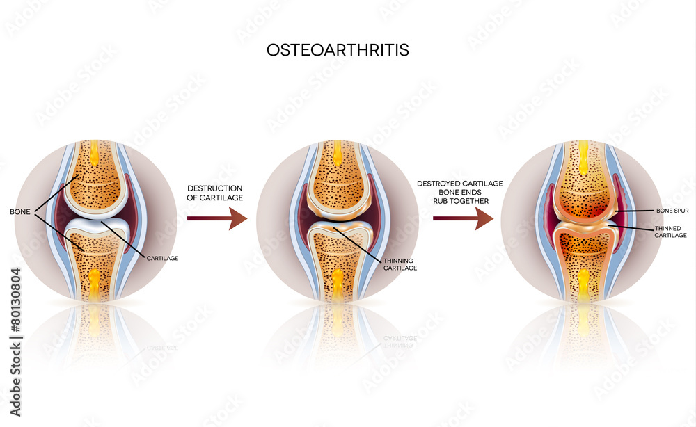 Osteoarthritis detailed illustration. From healthy joint to dama - obrazy, fototapety, plakaty 