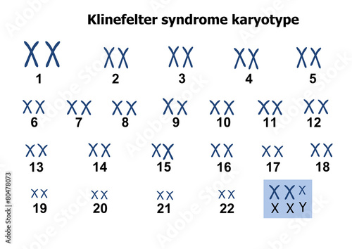 Klinefelter syndrome karyotype - Buy this stock vector and explore ...