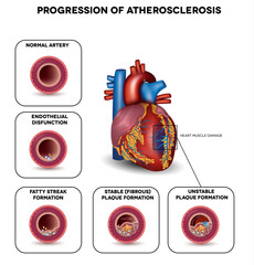 Wall Mural - Progression of Atherosclerosis till heart attack. Heart muscle d