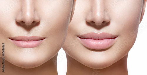 Fotomural Antes y después de las inyecciones de relleno de labios
