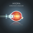 Myopia corrected by a minus lens. Myopia is being short sighted