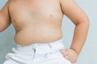 © kwanchaichaiudom - The size of stomach of children with overweight.