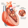 Defekte Aortenklappe.Risse an der Herzklappe