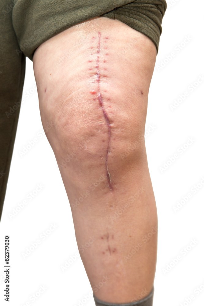 Seniorin mit frischer Narbe von Kniegelenk Operation Stock Photo | Adobe  Stock