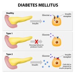 Wall Mural - Diabetes mellitus