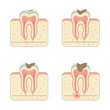 tooth decay disease, dental root tinfection