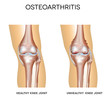 Healthy knee and knee with osteoarthritis on a white background
