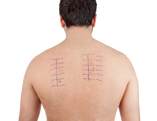skin allergy patch test on back