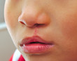Boy showing a monolateral cleft lip repaired.