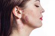 beautiful woman with port-wine stain (birthmark) on her face.

