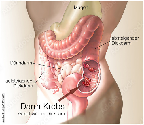 Naklejka - mata magnetyczna na lodówkę Darmkrebs.Geschwür im Dickdarm