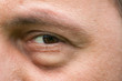 Eyesore, inflammation or bag swelling under eye