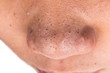 Close up pimple blackheads on the nose of a teenager