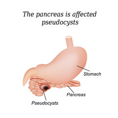 Wall Mural - Pancreas pseudocyst affected. Vector illustration on isolated