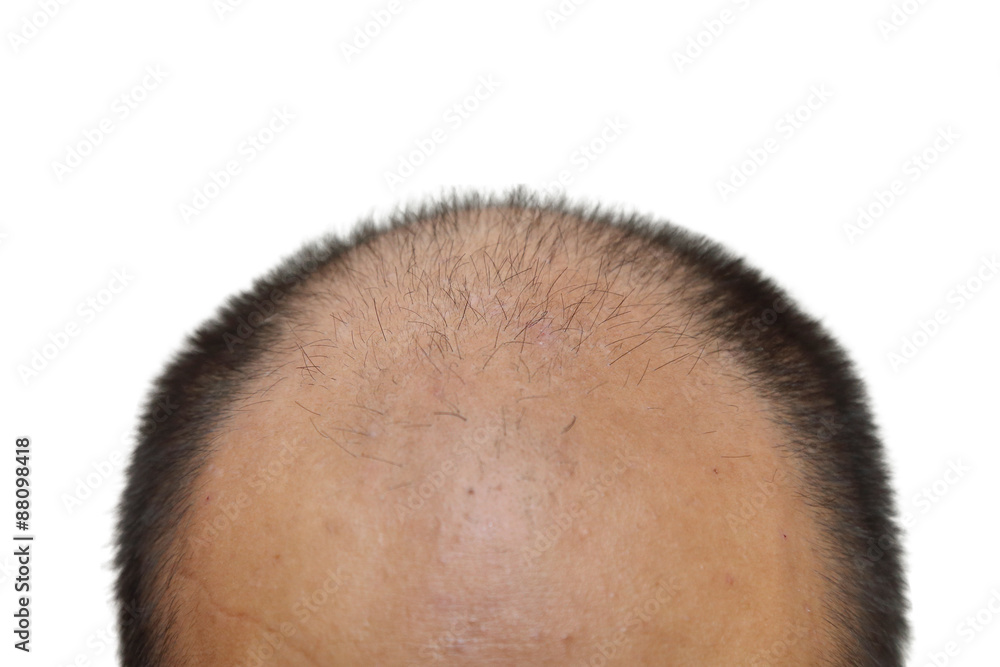 Photo Art Print Isolated Male With Hair Loss Symptoms Europosters