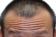 wrinkled forehead