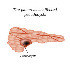 Wall Mural - Pancreas pseudocyst affected. Vector illustration on isolated