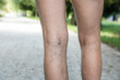 Painful varicose and spider veins on womans legs