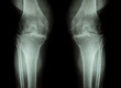 © stockdevil - Osteoarthritis Knee ( OA Knee ) ( Film x-ray both knee with arthritis of knee joint : narrow knee joint space ) ( Medical and Science background )