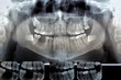 Dental radiography  Digital x-ray teeth scan of adult male