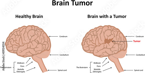 Brain Tumor Illustration Stock Vector | Adobe Stock