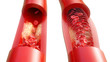 Arteriosklerose - Behandlung mit Stent