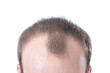 Man's Receding Hairline
