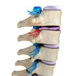 Spinal cord under pressure of bulging disc