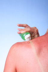 A woman applying Aloe Vera gel on her burned shoulder