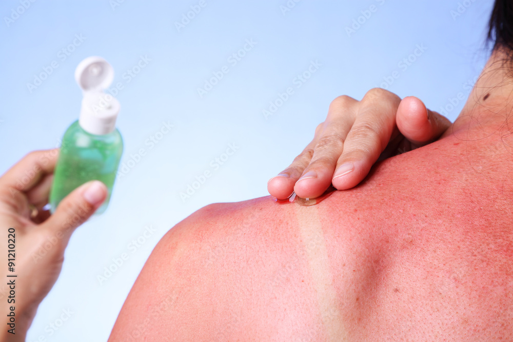 Woman rubbing aloe vera gel on her sunburned shoulder Stock Photo | Adobe  Stock