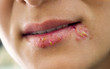 lips affected by herpes