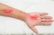 inflammation  wound in the forearm