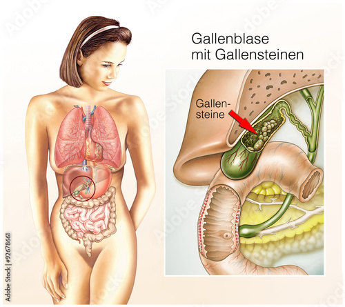 Obraz w ramie Gallensteine.Gallenblase.Verdauungssaft