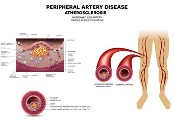 Poster - Leg artery disease, Atherosclerosis