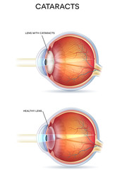 Sticker - Cataracts