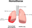 Hemothorax Illustration