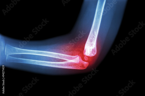 Fotografía Rheumatoid arthritis , Gouty arthritis ( film x-ray child 's elbow with arthriti