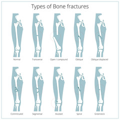 Wall Mural - Types of bone fractures medical educational vector