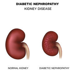 Wall Mural - Diabetic Nephropathy, kidney disease