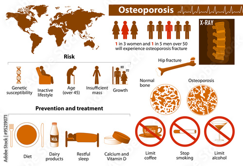 Cuadros en Lienzo osteoporosis infographic