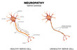 Neuropathy, nerve damage