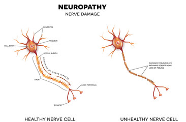 Wall Mural - Neuropathy, nerve damage