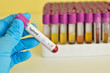 Typhoid positive blood sample