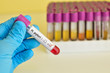 Helicobacter pylori positive blood sample